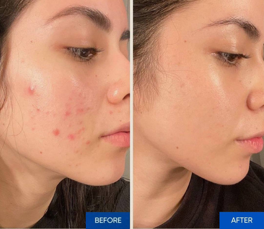 Revi Touch™ Microcurrent Smart Massager