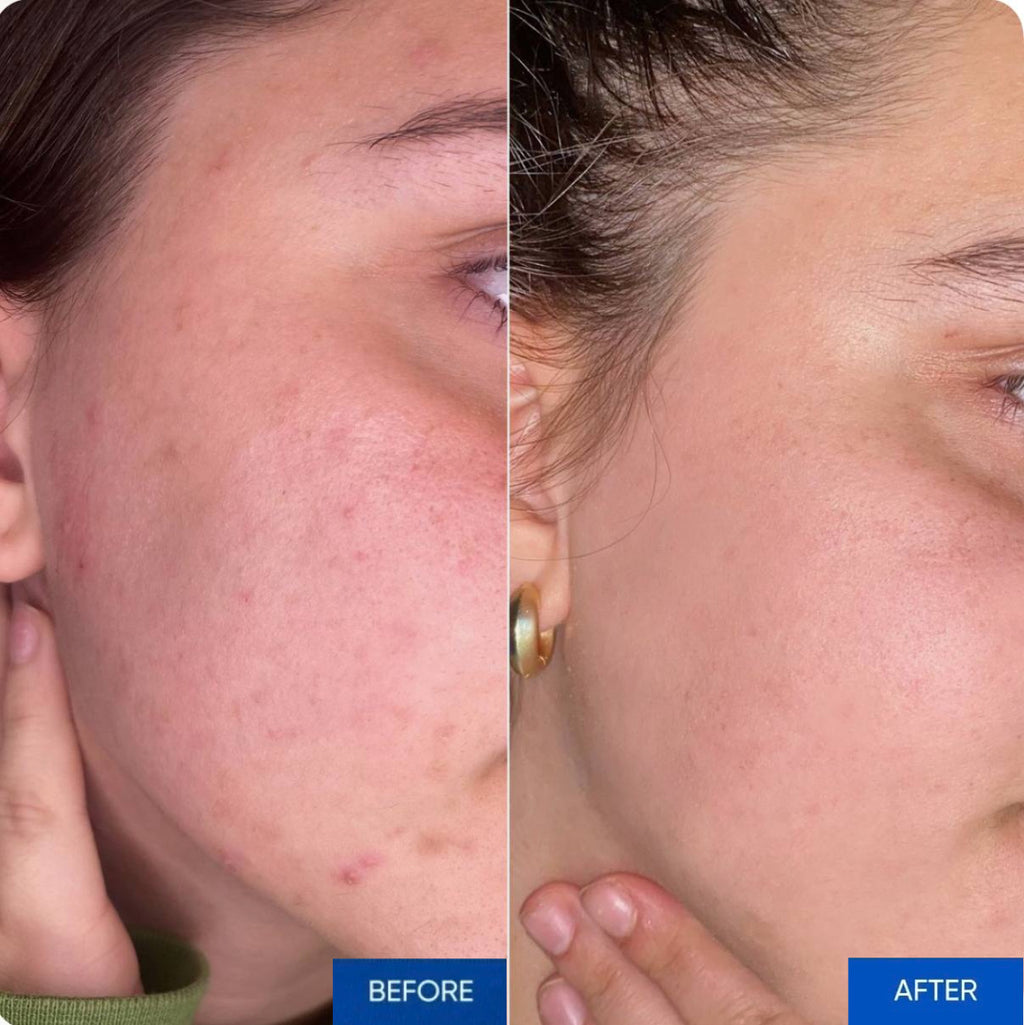 Revi Touch™ Microcurrent Smart Massager